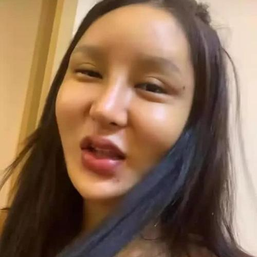 整容|桃花宝宝多次整容留后遗症,脸形像胖头鱼,长相不如从前好看