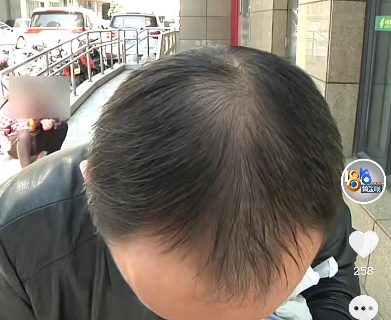 浙江:男子做“新生植发”,三个月后头发掉没了,网友:发型很帅