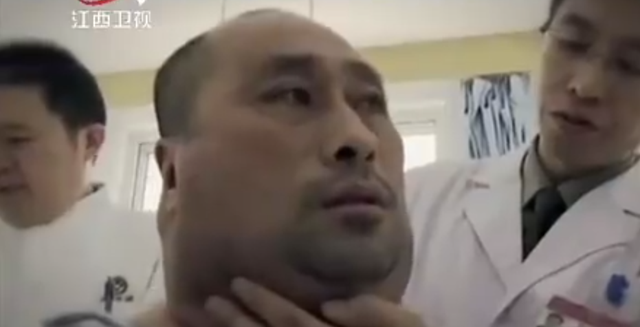 东北男子嗜酒如命,20年喝下30000斤酒引发怪病,医生:治不了