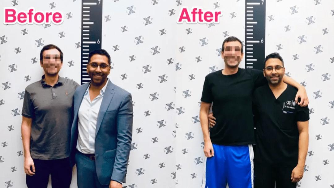 硅谷|邪术or神之手：硅谷男精英的“断骨贷”，到底有多可怕？