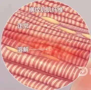 运动|杭州男子一个自信操作，结果路都走不了！最近很多人想“填坑”，但这事真急不得...