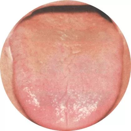 失眠|中医中的舌诊,了解吗