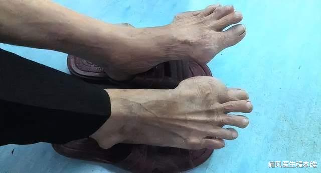 痛风|痛风治疗，这4件事真的很重要