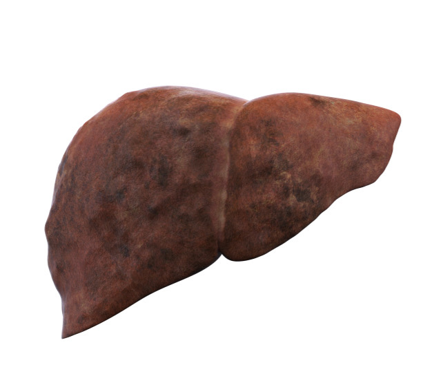 |肝硬化是“拖”出来的!再三忠告:头部出现4种异常,肝脏或已“烂如筛子”