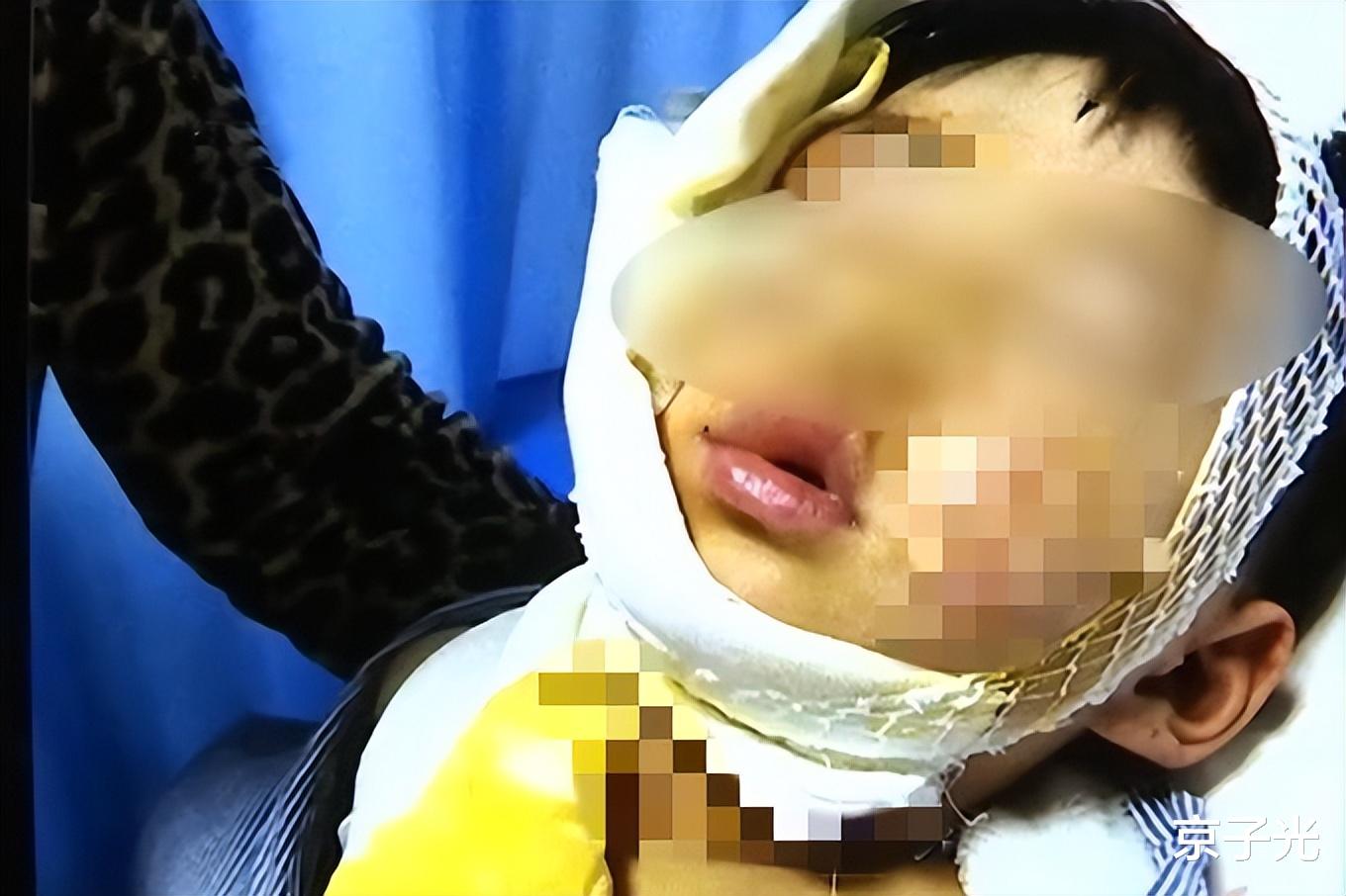陕西女子带侄儿吃流水席被烫伤,向主家索赔遭拒:家长去哪儿了?