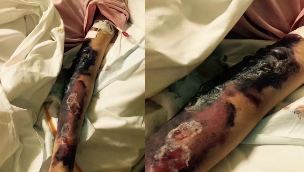 徐婷|现实中的“樊胜美”:被家人当做印钞机,因生病全身溃烂而去世