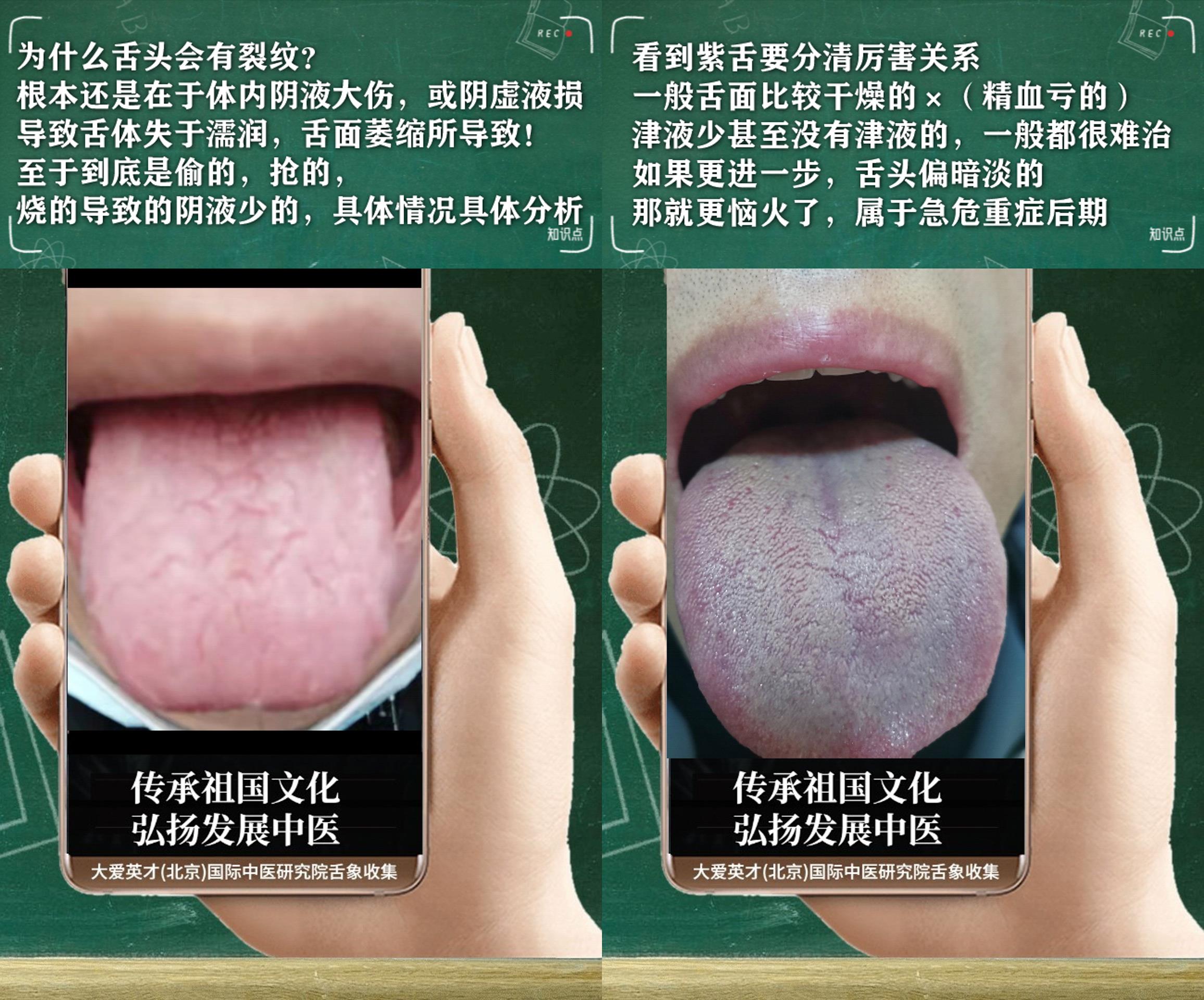 |中医分析:很懦弱,四肢浮肿,痰多,经常复发非常崩溃