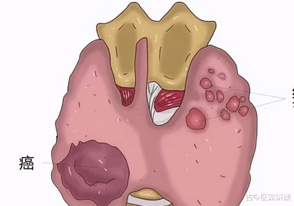 水果|多所医院联合声明:鸡肉和它一起吃,简直是”自毁甲状腺“,趁早远离