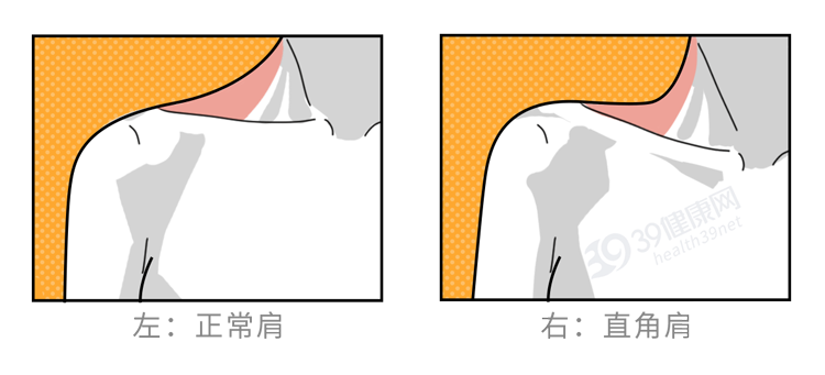 饮食|骨盆前倾危害大，如何鉴别和矫正？1个方法判断，2个动作缓解