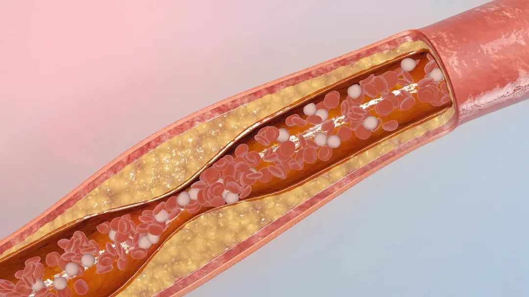 运动|血管堵塞,脚部可能会出现这些异常!3个简单动作,可有效改善