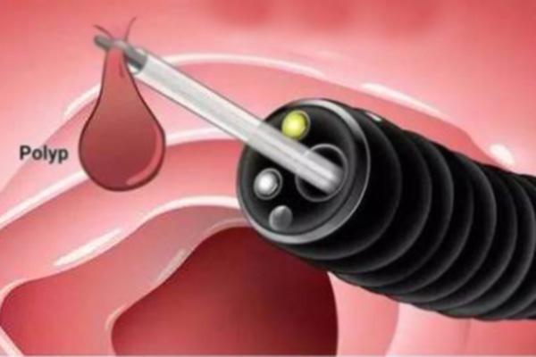 医生|肠息肉毫无征兆？上厕所若有这三种表现，或是肠道“长”息肉了！