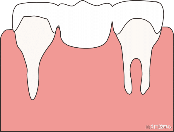 肿瘤|三种缺牙修复方式对比，看完摆脱选择困难症