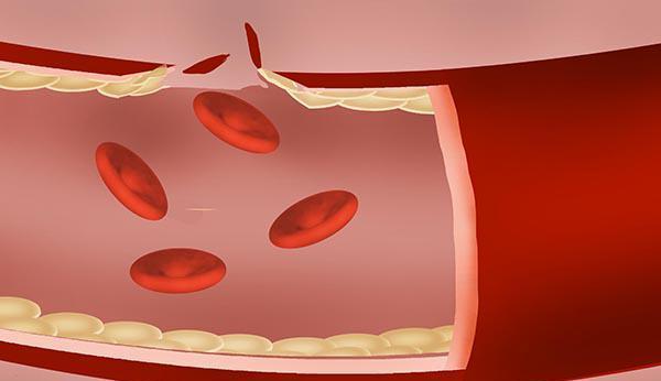 香脆可口的猪油渣,中老年人能不能吃?猪油真是“血管杀手”吗?