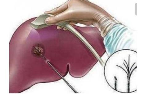 体检|体检查出病，先别慌，若是这4种病，可能不治疗也没啥事