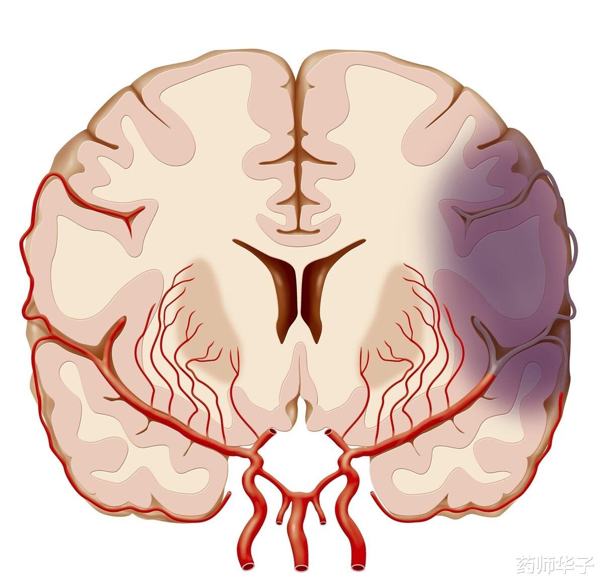 脑梗塞|预防脑梗塞的发生，不能只靠补叶酸，还要注意这2种疾病