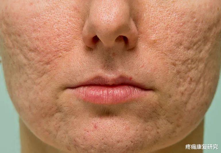 痤疮|痤疮瘢痕的康复治疗