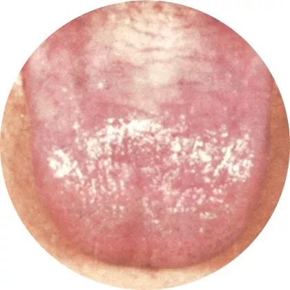 失眠|中医中的舌诊，了解吗