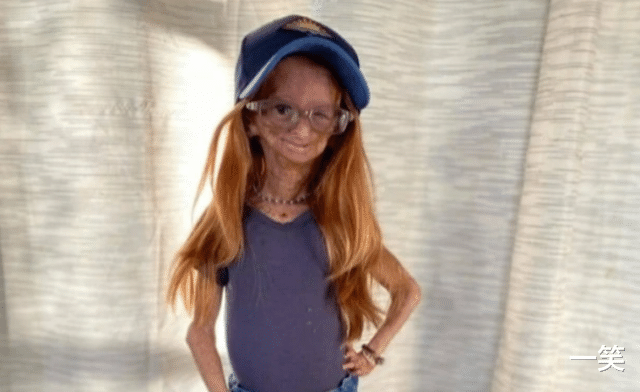 早衰症|知名网红阿达莉亚·罗斯因早衰症去世，年仅15岁，家人公布死讯