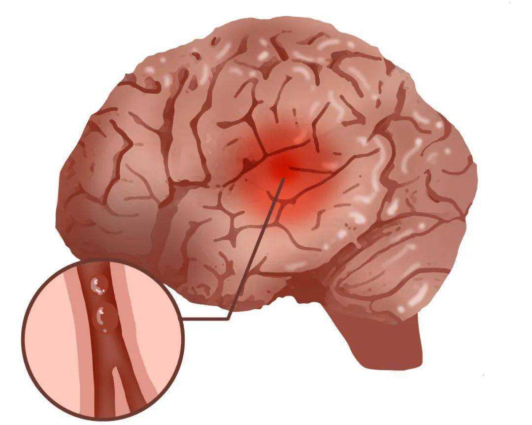 儿科|一天7人脑梗,最年轻的才23岁!预防心脑血管病从现在做起!