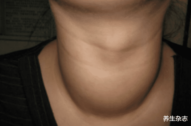 甲状腺癌|身上这里长出“肉疙瘩”,或是甲状腺癌前兆?30岁以上尤其注意