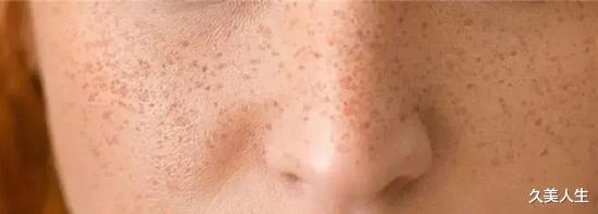 黑色素 去年美白又翻车了?点进来补课!