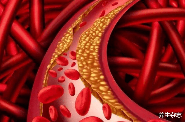 心力衰竭|血管“天敌”被扒出,提醒:停止食用“1酸”,多吃一口,血管多堵一分