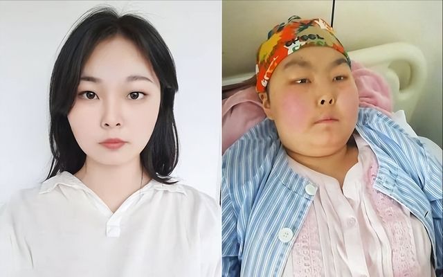 漂亮女大学生患病后容貌突变让人心疼,七旬爷爷为救孙女工地搬砖