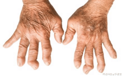 |类风湿患者需要补充的三种维生素 你还不知道吗?