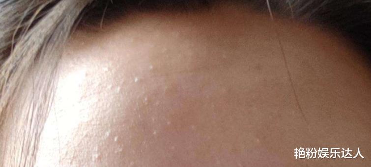 护肤品|爱长痘、有闭口的女生,这些“护肤技巧”请收好,还你白嫩水光肌