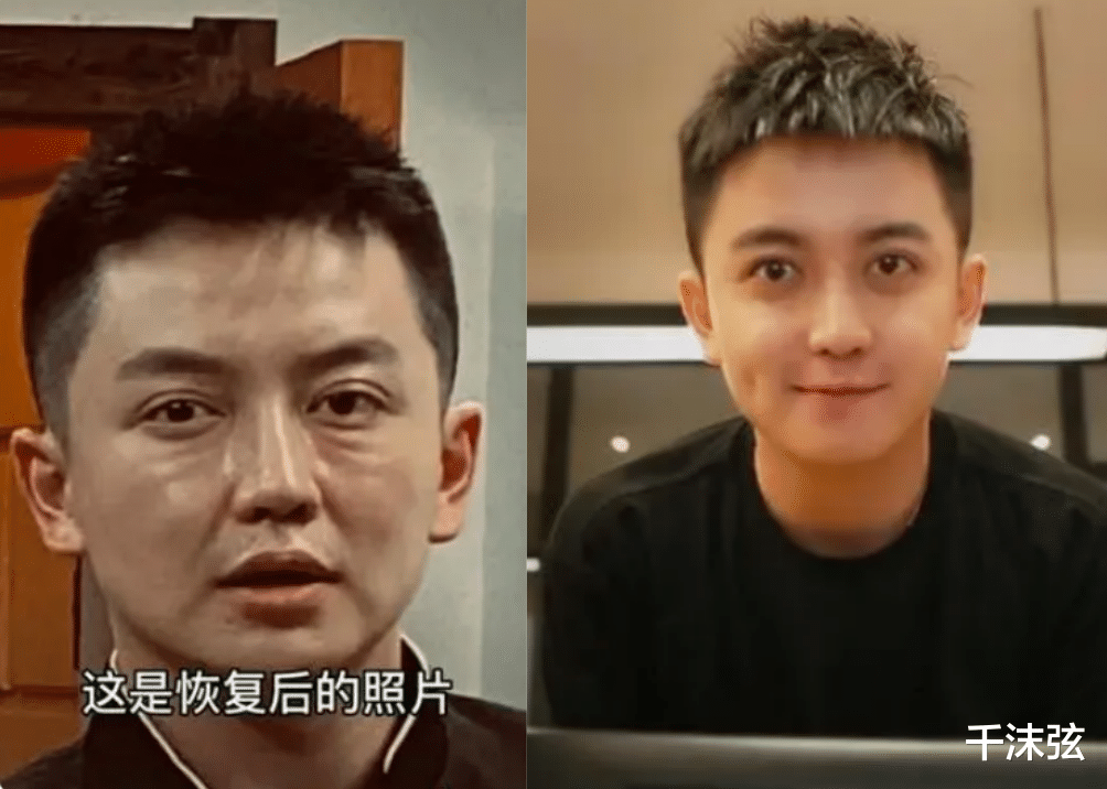 整容|55岁张蔷自曝整容失败！素颜怼脸大方展示疤痕，吐槽医生不认真