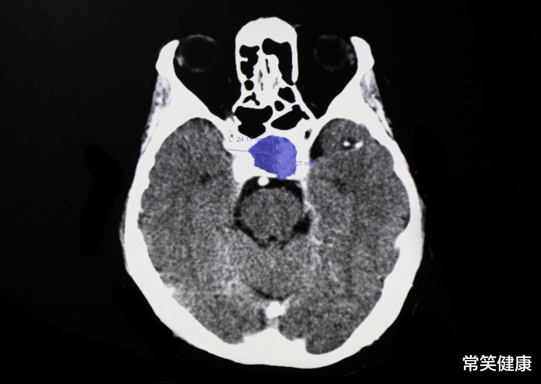 疾病|男女出现这6种面相,不是大病就是瘤!偏偏很多人还不自知!