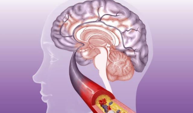 养生|血栓“大户”或被揪出,堪比肥肉,医生:常吃,血管或许扛不住