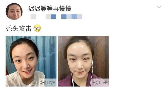 孙俪|孙俪妹妹自曝脱发严重险秃头!在线求助惹心疼,网友调侃:植发了解一下