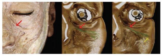 熊师:印第安纹的解剖学特点与治疗进展丨专业视点