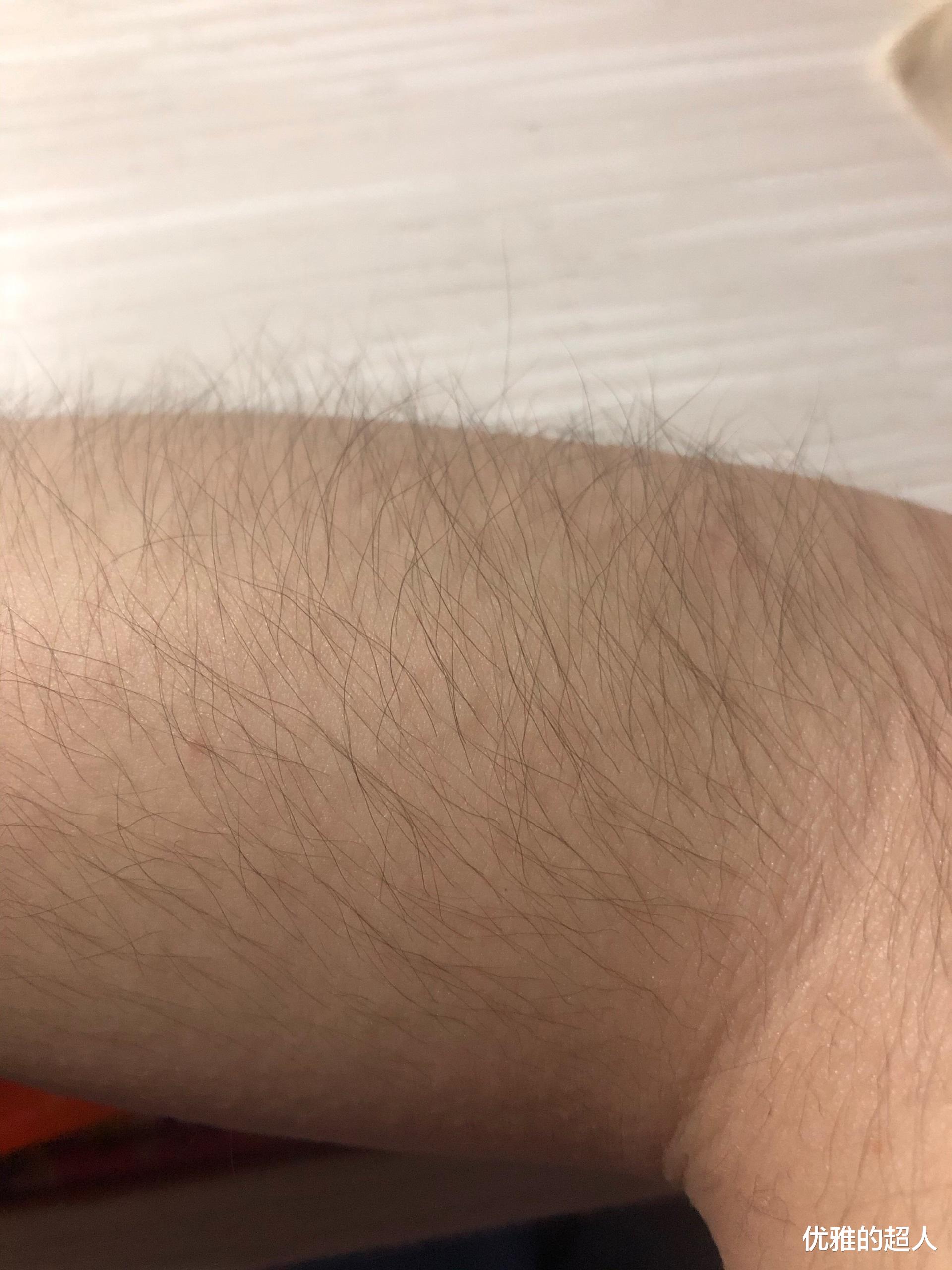 腰椎间盘突出|皮肤出现这8种变化，可能是癌症发出的信号！