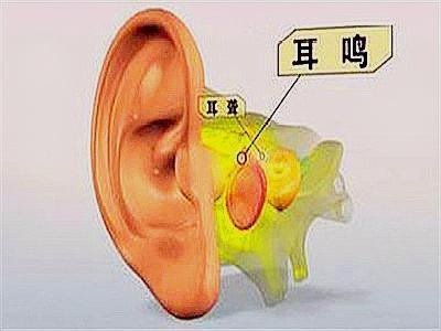 黑色素瘤|耳朵总是有异响,让人很不舒服,可以试试穴位调理法,会有帮助的