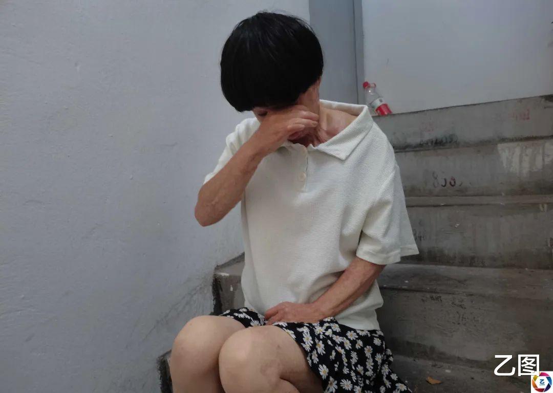 打工妹被女同事泼香蕉水点燃毁容,漂亮的模样如今成痛苦的记忆