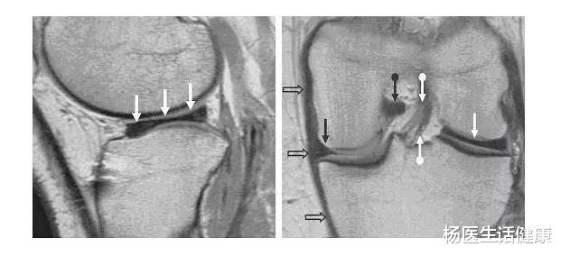 祛湿|一位患者说:你说半月板损伤不是病,你就是否认核磁检查科学的科学性