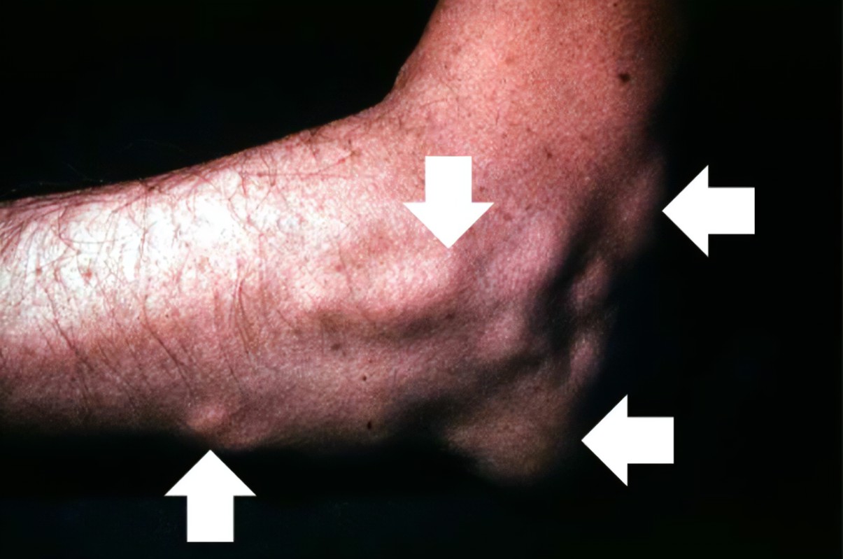 降压药|发现“痛风石”,必须尽快手术?医生辟谣:3种情况,才应该手术