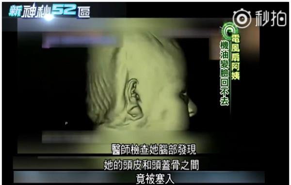 王一博|女星韩慧景:为了更漂亮,给脸注射食用油,把脸整成“猪头”