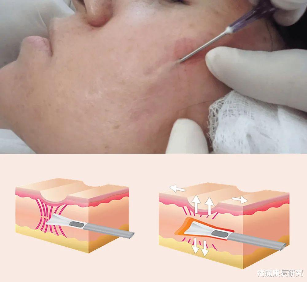 痤疮|痤疮瘢痕的康复治疗