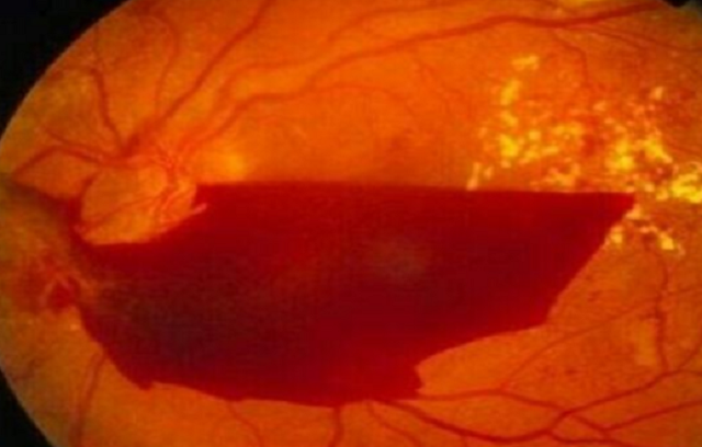 |一个人如果如果血脂高了，身体会有3个提示，3个方法让血液不稠的方法