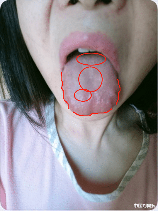 饮食|粉丝舌象分析