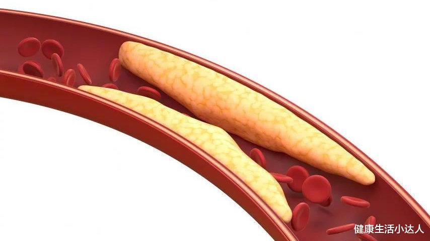 静脉曲张|血脂“超标”了,身体会有5个“信号”,控制血脂先管住嘴