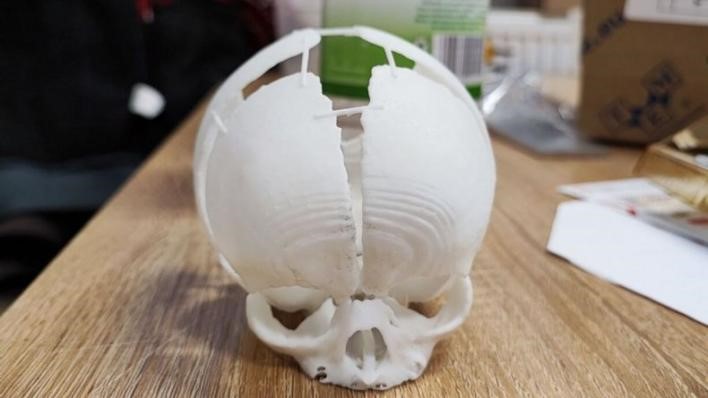 何同学|3D打印的头骨拯救了大脑暴露的新生儿！