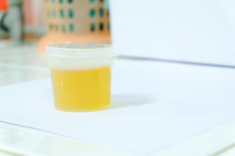 膀胱癌|大小便出现5种变化，有可能是癌症的征兆，该做做检查了