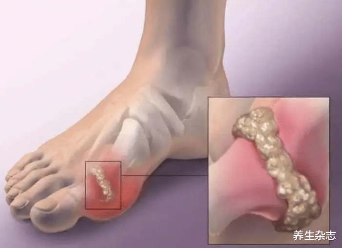 痛风|嘌呤“大户”公布,是猪肉的20倍,若你常吃,痛风或会不请自来!