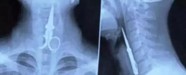 肺癌|盘点30张奇奇怪怪的X光片，看完整个人都不好了！