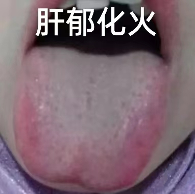 直肠癌|入睡难、易惊醒、噩梦多?分享六种中成药,帮你解决各种失眠问题