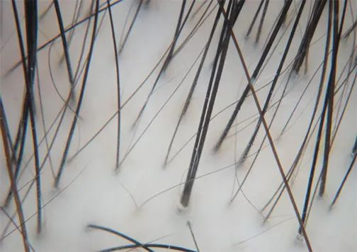 针灸|男人为啥一边秃头,一边长胡子?